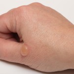 Bulla (blister) B