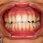 Gingival line